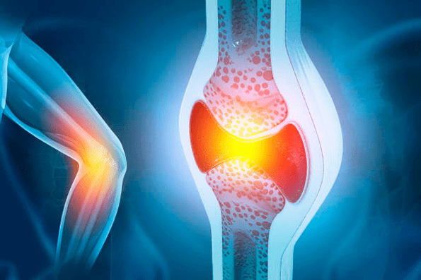 Preprečevanje bolezni sklepov